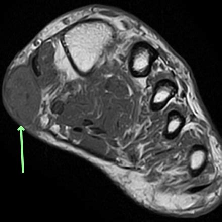 The interosseous muscles of the foot are muscles found near the metatarsal bones that help to control the toes. Foot - Plantar fibromatosis - MRI Online