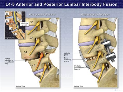 L4 5 Anterior Posterior Lumbar Interbody Fusion Trial Exhibits