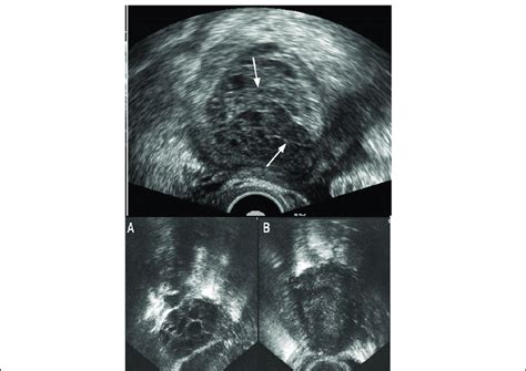 Cyst Vs Tumor Ultrasound
