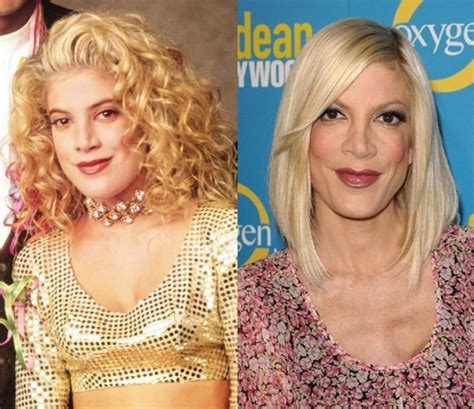 Tori Spelling Before And After Plastic Surgery 03 Celebrity Plastic