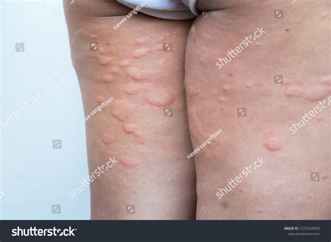Skin Rash Legs Stock Photo 1273243093 Shutterstock