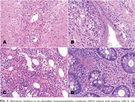 Figure 1 From Can Anca Differentiate Eosinophilic Granulomatosis With