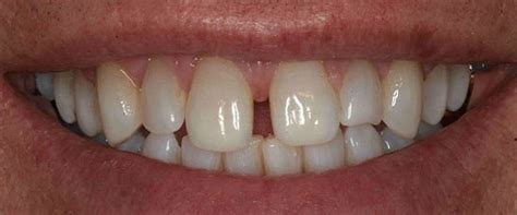 4 Porcelain Veneers On Upper Front Teeth