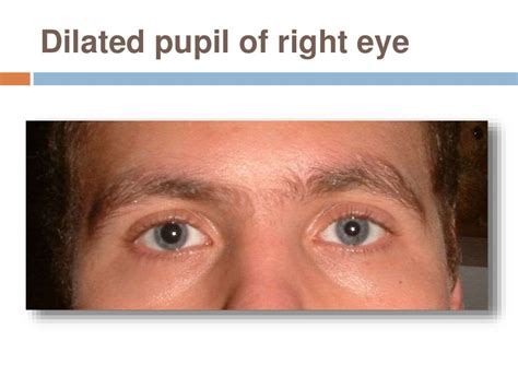 Abnormalities Of Pupil