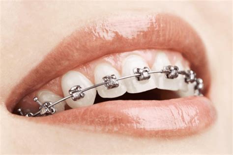 Damon Braces Smile Council Orthodontics Smile Council Orthodontics