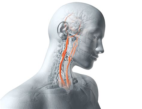 Carotid Artery Surgery Could It Give You A Stroke Readers Digest