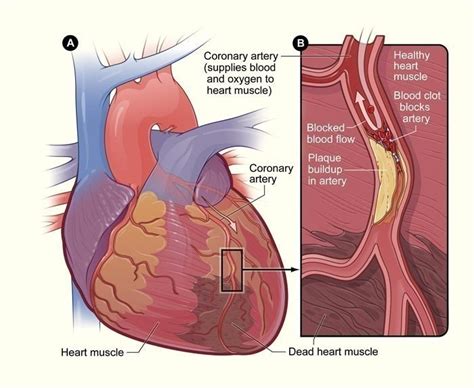 Heart Blockage Symptoms Medical Symptoms Guide