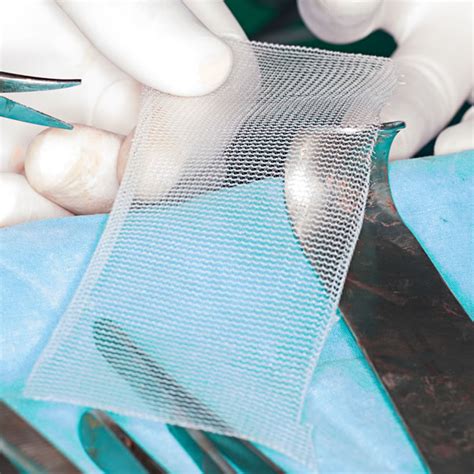 If the mesh used in your hernia repair surgery was defective and caused the mesh to tear or rip if you have had hernia repair surgery and subsequently suffered a torn mesh implant, you may wonder. Hernia Mesh - GTBS Law
