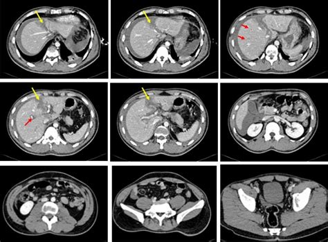 CT Findings Of Periportal Tracking In Blunt Liver Injury Radiology Cases