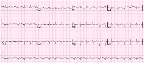 Dr Smiths Ecg Blog Right Sided Heart Failure And Tachycardia