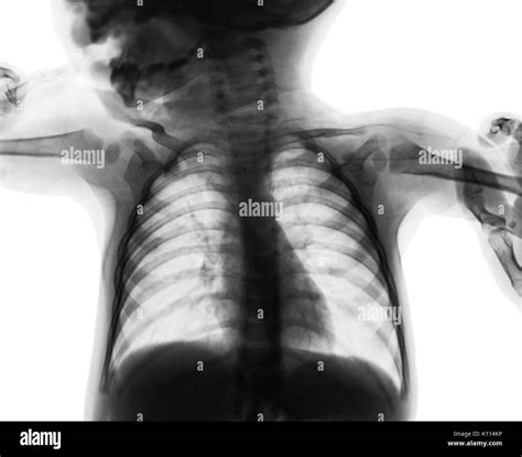 Film Chest X Ray Of Child Isolated Background Stock Photo Alamy