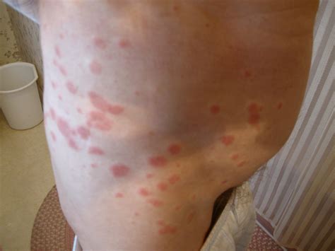 Rash On Lower Stomach Pictures Photos