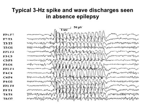 3 Hz Spike And Wave Absence Slidedocnow