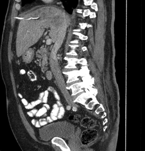 Abdominal And Pelvis Computed Tomography With Oral And Intravenous