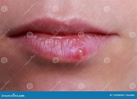 Herpes On The Lips Stock Photo Image Of Herpes Closeup 116258346
