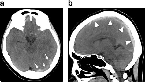 Noncontrast Head Computed Tomography A Axial And B Sagittal Views