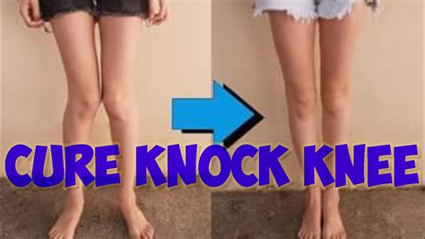 Treat Knock knee with Home Based Exercises घरम बसर नक न Knock
