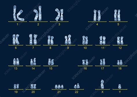 male karyotype with down s syndrome stock image c016 6749 science photo library