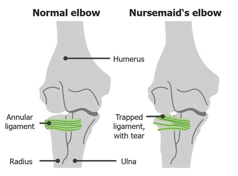 Radial Head Subluxation Nursemaids Elbow Concise Medical Knowledge