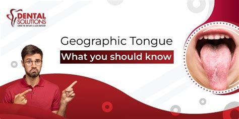 Geographic Tongue Causes And Treatment