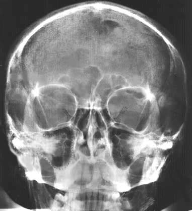 Lecture on x ray skull (a/p view). Skull (Anterior-Posterior, Caldwell) - NU-FSOM X-Ray Program