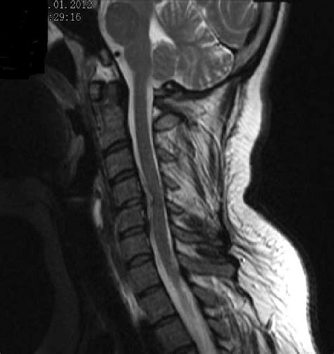 T2 Weighted Sagittal Magnetic Resonance Imaging Of The Cervical Spine
