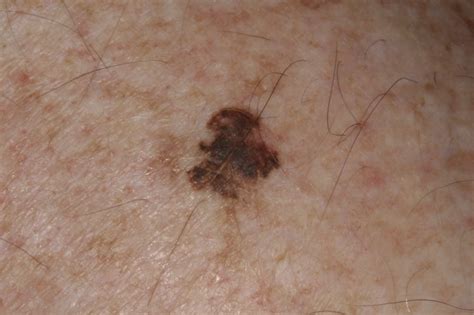 Cancer Melanoma Skin Cancer