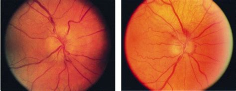 Features Of Amiodarone Induced Optic Neuropathy American Journal Of