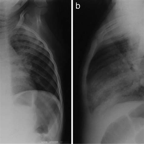 Anteroposterior A And Lateral B Chest Radiographs Of A 7 Year Old