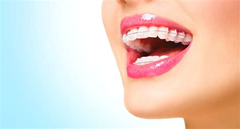 Our Selection Of Adult Braces At Cliftonville Northampton Dentist