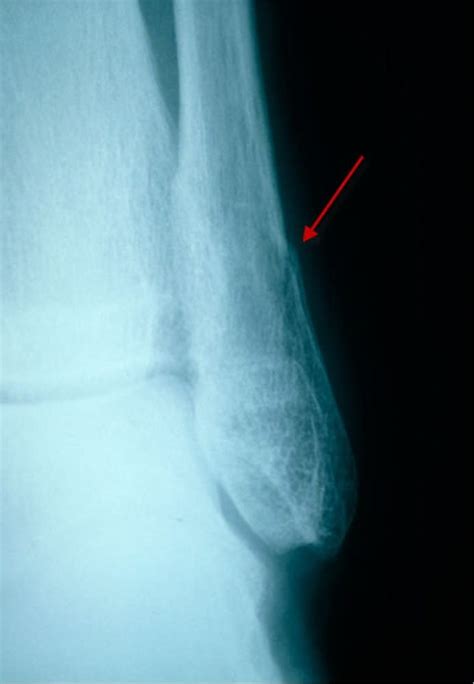 Image Subtle Distal Fibular Fracture Lateral View Msd Manual