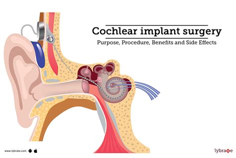 Cochlear Implant Treatment Procedure Cost Recovery Side Effects