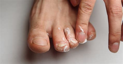 Best Ways To Prevent And Treat Athletes Foot Fungus At Home This