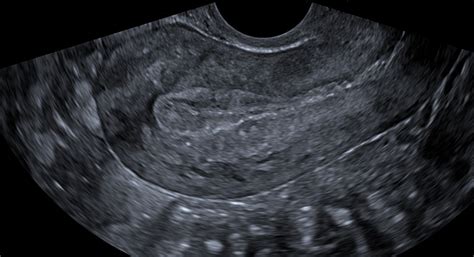 Pelvic Ultrasound Insight Medical Imaging
