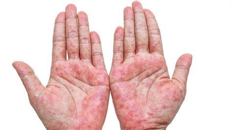 Types Of Skin Rashes Explained
