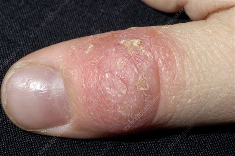 Eczema Affecting The Thumb Stock Image M1500362 Science Photo