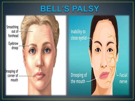 Facial Nerve Palsy By Dr Chandra Prakash Arya Bsc Bds Mds P