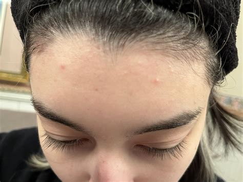 Routine Help Tiny Red Forehead Bumps Rskincareaddiction