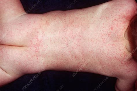 Roseola Infantum Stock Image C0031305 Science Photo Library