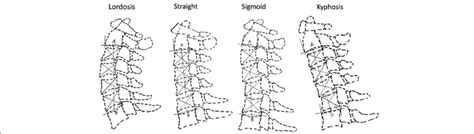 The Classification Of Cervical Alignment As Lordosis Straight Sigmoid