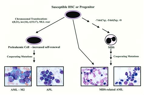 Acute Leukemia A Pediatric Perspective Cancer Cell