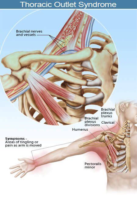 Thoracic Outlet Syndrome Tests Treatment Symptoms Anatomie Und