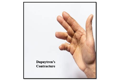 Dupuytrens Contracture Causes And Treatment Dr Vasudeva