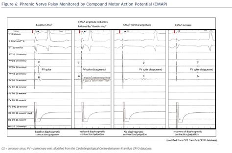 figure 6 phrenic nerve palsy monitored by compound motor action potential cmap radcliffe