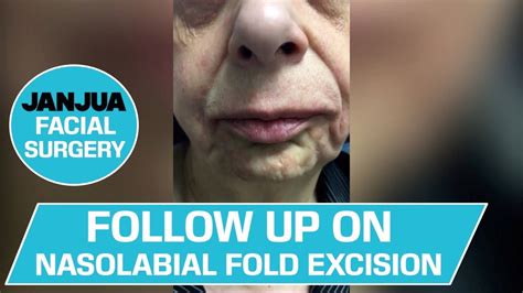 Long Term Follow Up On Nasolabial Fold Excision Dr Tanveer Janjua
