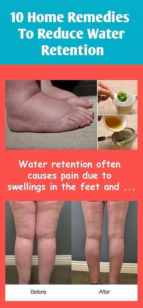 10 Home Remedies To Reduce Water Retention Water Retention Water