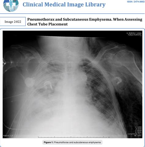 Figure 1 From Pneumothorax And Subcutaneous Emphysema When Assessing
