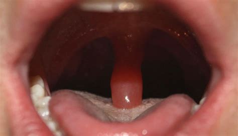 10 Home Remedies To Treat Swollen Uvula
