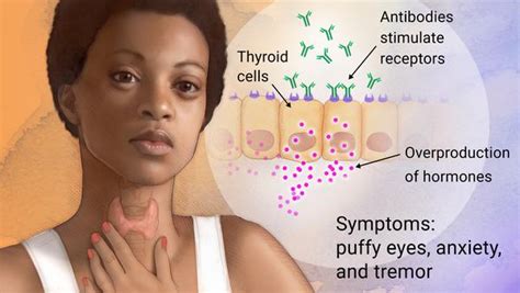 Signs and symptoms, diagnosis and treatment. Archive Of Standardized Exam Questions: Graves Disease ...