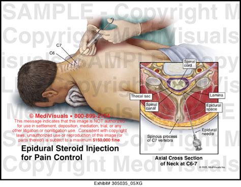 Epidural Steroid Injection For Pain Control Medical Illustration